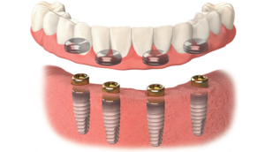 InnovaImplantCenter-Snap-On-Denture