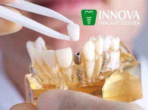 Best-implant-dentist-in-alexandria-VA-innova-dental-implant-center Best-implant-dentist-in-alexandria-VA-innova-dental-implant-center