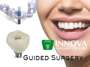 Dental-Implants-in-Alexandria-VA-Guided Surgery-Implants-Innova-Implant-Center