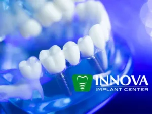 Dental-Implants-in-Alexandria-VA-Next-Day-Implants-Innova-Implant-Center Dental-Implants-in-Alexandria-VA-Next-Day-Implants-Innova-Implant-Center