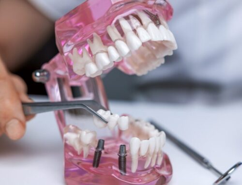 A Guide to the Various Types of Dental Implants