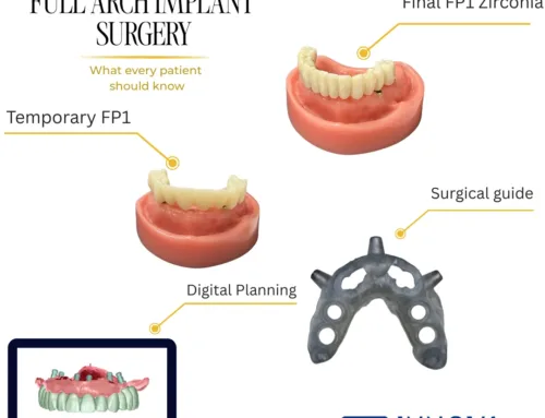 Before Full Arch Implant Surgery: What Patients Wish They Knew
