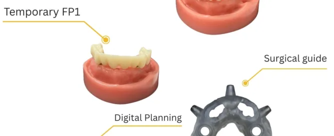 Before-full-arch-implant-surgery-guide-featuring-digital-planning-temporary FP1-final-zirconia-bridge-and-surgical-guide